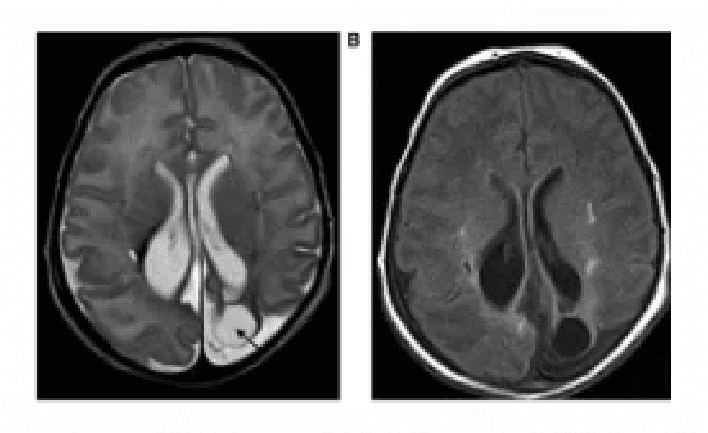Dos resonancias magnéticas axiales de un cerebro
